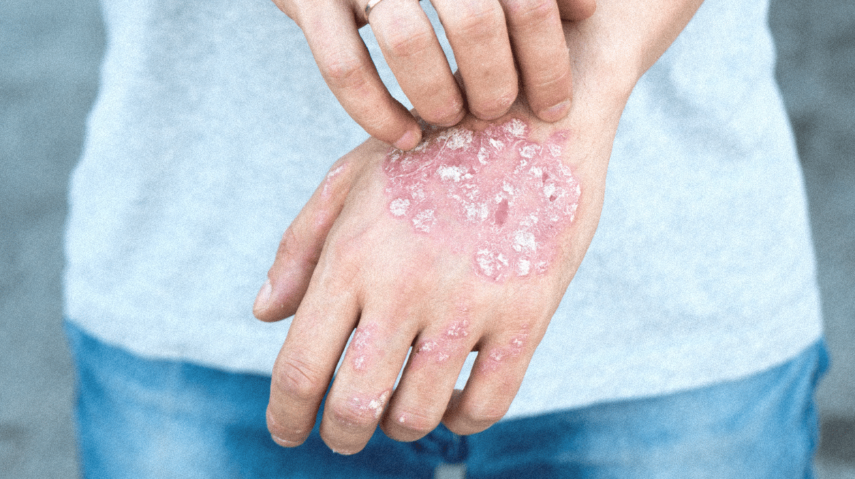 Quels sont les meilleurs traitements contre le psoriasis ?